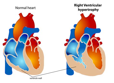 causes of right ventricular enlargement.